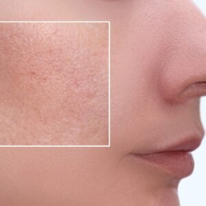 Tratamento Facial de Cicatriz de Acne e Poros Dilatados